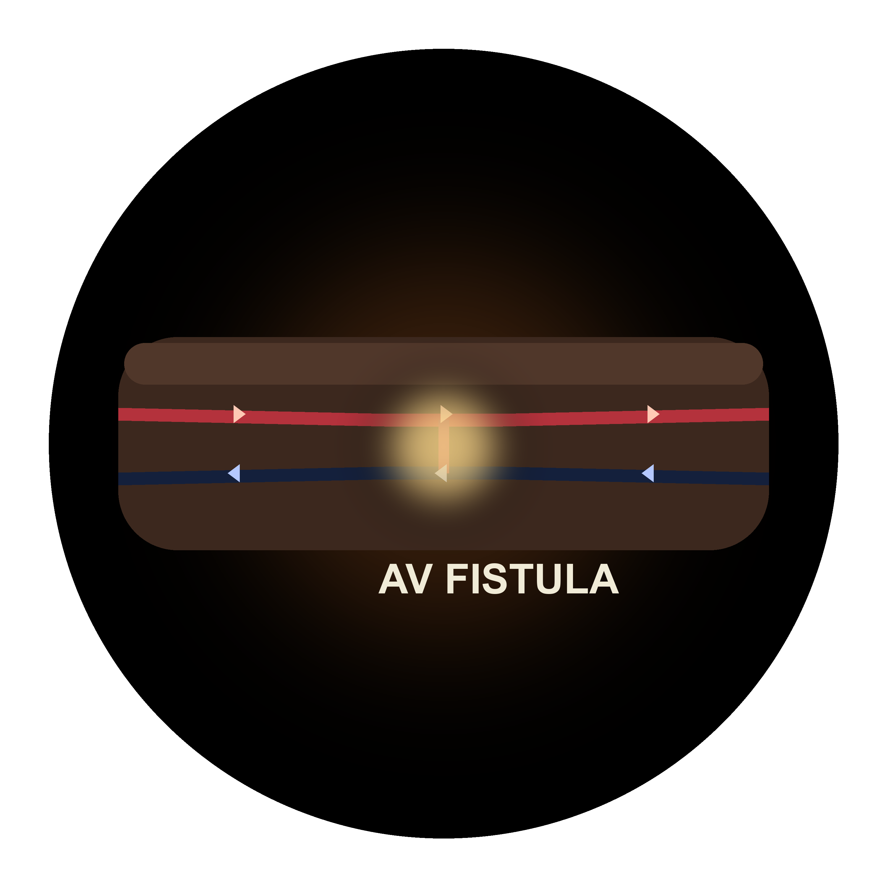 Fistula Diagram